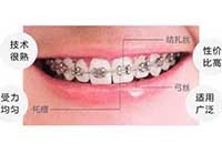 金屬非自鎖托槽矯正