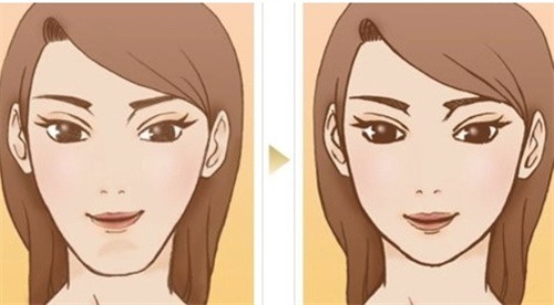 沈陽(yáng)杏林朱石江醫(yī)生做頜面手術(shù)口碑好，下頜角整形3.2w+享精致輪廓