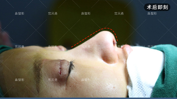 宮風(fēng)勇做鼻子的個人體驗分享