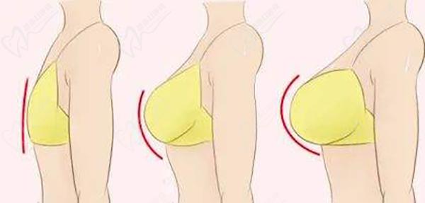 蘇州聶志宏隆胸技術(shù)怎么樣