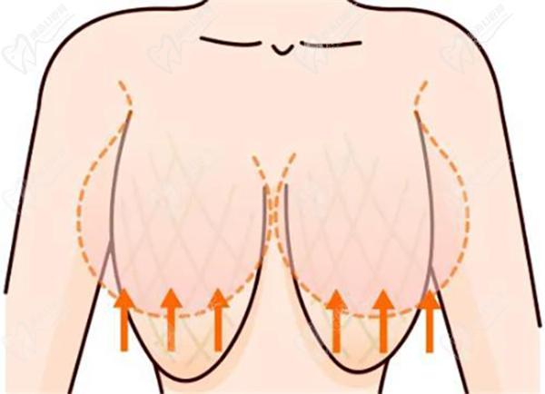 蘇州聶志宏隆胸技術(shù)優(yōu)勢