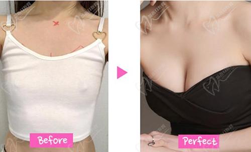 韓國普羅菲耳隆胸及胸部修復(fù)