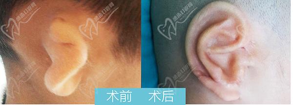 八大處耳再造手術(shù)哪個(gè)醫(yī)生好