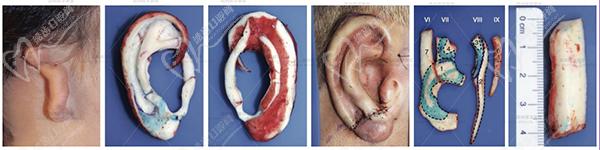 八大處耳再造手術(shù)哪個(gè)醫(yī)生好