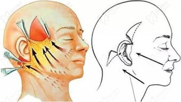 上海九 院丁偉做拉皮怎么樣