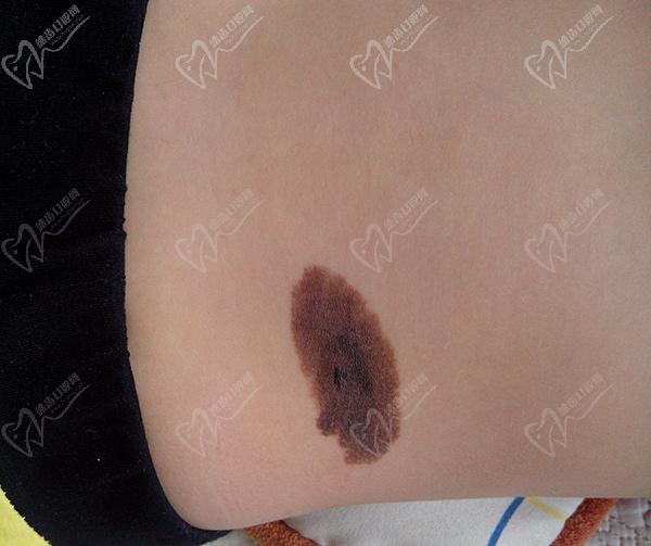 色素細(xì)胞失活技術(shù)治療咖啡斑