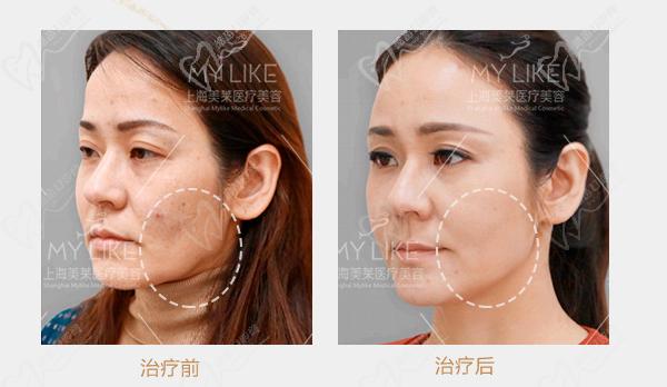 上海美萊醫(yī)院注射價(jià)格表