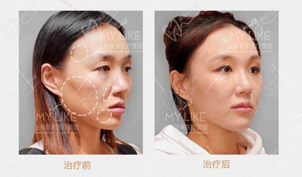 上海美萊TAC輪廓抗衰優(yōu)勢