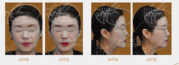 上海美萊TAC輪廓抗衰優(yōu)勢