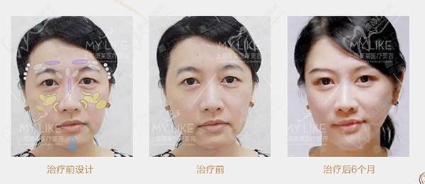 上海美萊填充誰蕞好