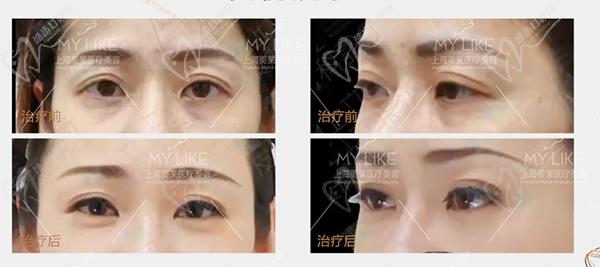 上海美萊填充誰蕞好