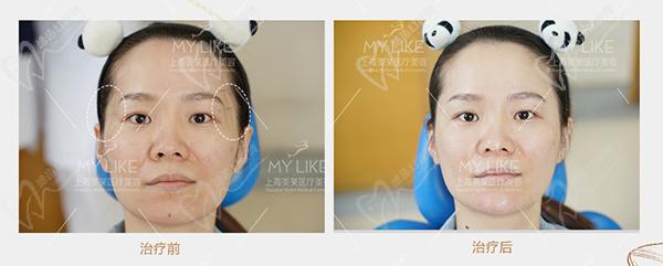 上海美萊輪廓抗衰口碑案 例圖片參考