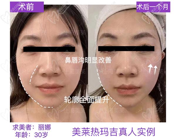 上海美萊醫(yī)院3C-WT云感熱瑪吉范例參考