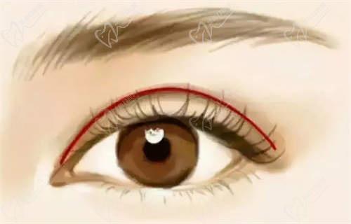 沈陽杏林整形醫(yī)院雙眼皮手術(shù)