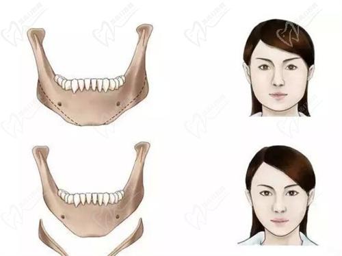 沈陽(yáng)杏林朱石江醫(yī)生下頜角整形