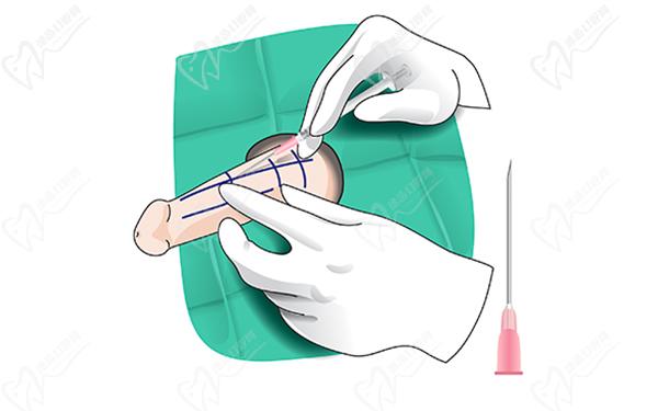 玻尿酸男性增大注射要多少錢(qián)