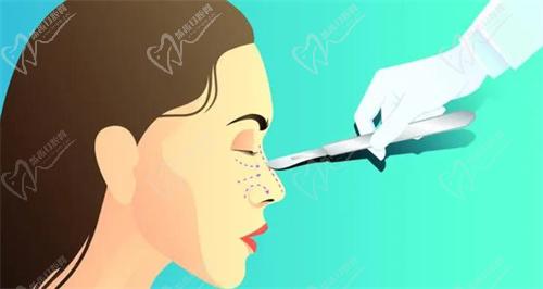 美國射極峰隆鼻的優(yōu)勢