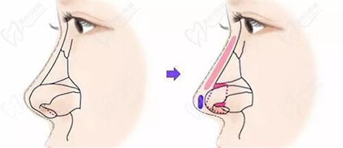 自體軟骨墊鼻尖的優(yōu)勢