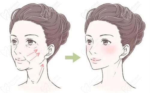 沈陽杏林整形醫(yī)院拉皮