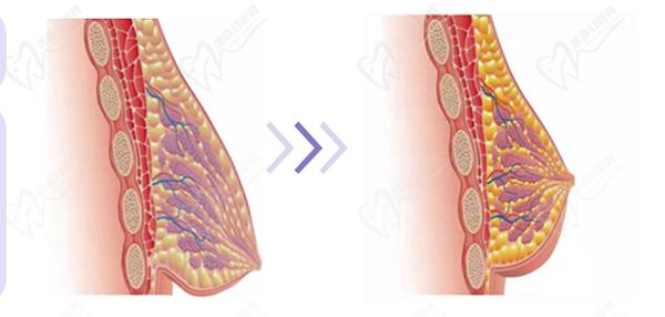深圳南雅整形醫(yī)院做提胸手術(shù)怎么樣？