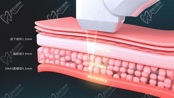 沈陽超聲炮哪個醫(yī)院做的好