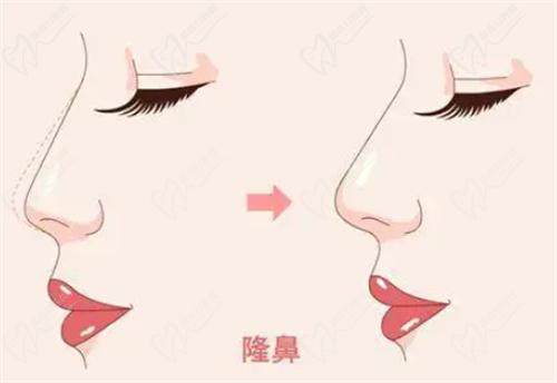 毛運(yùn)春醫(yī)生做鼻子怎么樣？