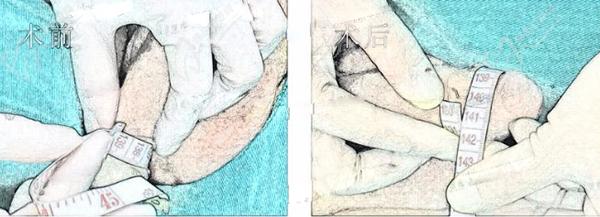 男性自體延長(zhǎng)手術(shù)多少錢