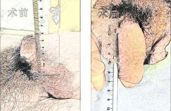 男性自體延長(zhǎng)手術(shù)多少錢