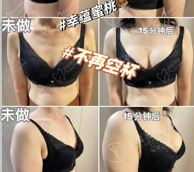 幸蘊(yùn)15分鐘無痕豐胸價(jià)格