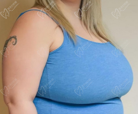 乳房縮小手術有什么后遺癥