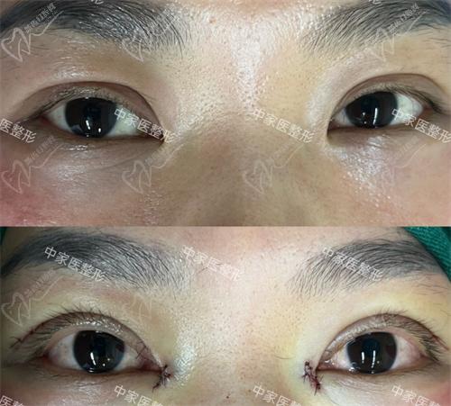 田芳斌醫(yī)生眼修復(fù)真人實例