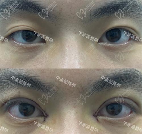 田芳斌醫(yī)生眼修復(fù)真人實例