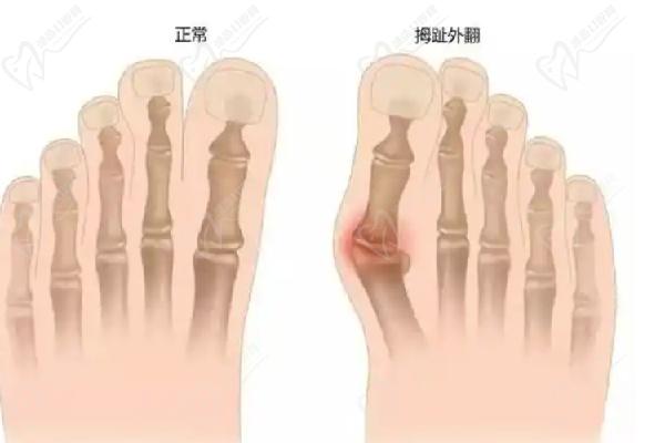 溫建民大腳骨醫(yī)院