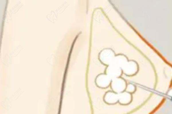 北京英煌間聯(lián)祖細(xì)胞豐胸的優(yōu)勢(shì)