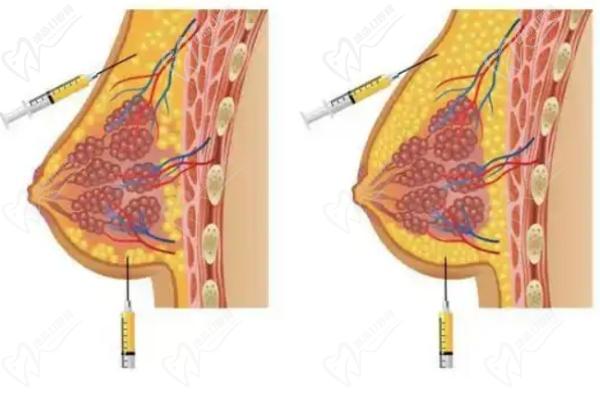 北京英煌間聯(lián)祖細(xì)胞豐胸總結(jié)