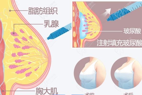北京英煌間聯(lián)祖細(xì)胞豐胸