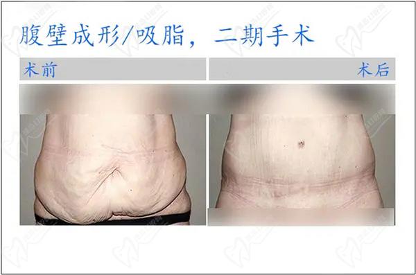 瞿健醫(yī)生腹壁整形