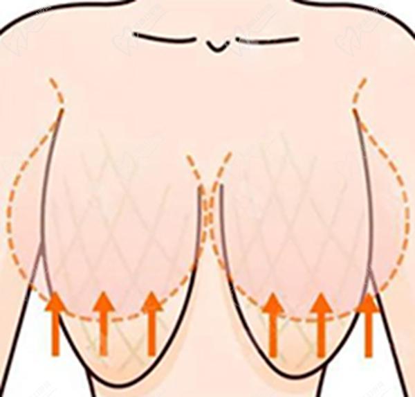 沈陽(yáng)胸部懸吊術(shù)誰(shuí)做的好