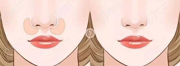 上海葉麗萍醫(yī)生做鼻基底手術嗎？