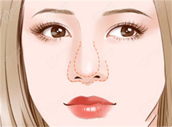 上海葉麗萍醫(yī)生做鼻基底手術嗎？