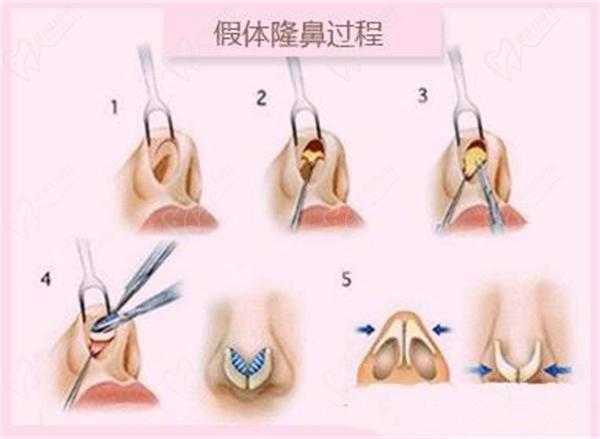 上海葉麗萍醫(yī)生做鼻基底手術嗎？