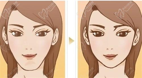 沈陽杏林朱石江醫(yī)生做頜面手術(shù)口碑好，下頜角整形3.2w+享精致輪廓