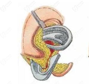 段偉強(qiáng)耳再造有名,在東籬醫(yī)院坐診在線(xiàn)可預(yù)約,分享幾組段偉強(qiáng)耳再造案例