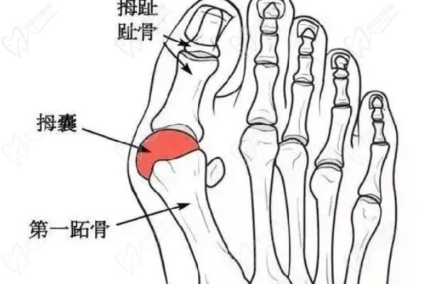 溫建民骨科醫(yī)院在哪里：在北京京望醫(yī)院坐診大腳骨手術(shù)非常擅長(zhǎng)治療費(fèi)2W左右
