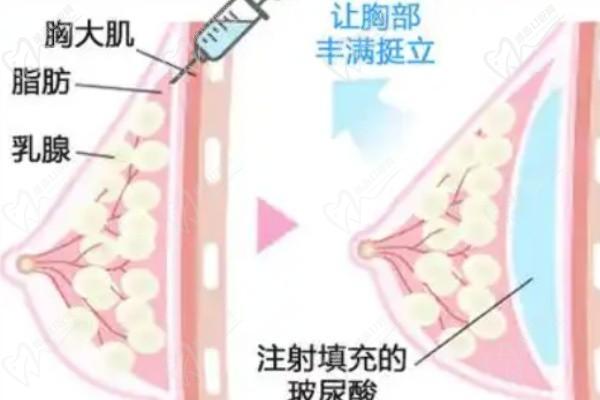 北京英煌間聯(lián)祖細(xì)胞豐胸怎么樣？適合大尺度豐胸?zé)o異物感,脂肪豐胸排名前十的項(xiàng)力源醫(yī)生可手術(shù)
