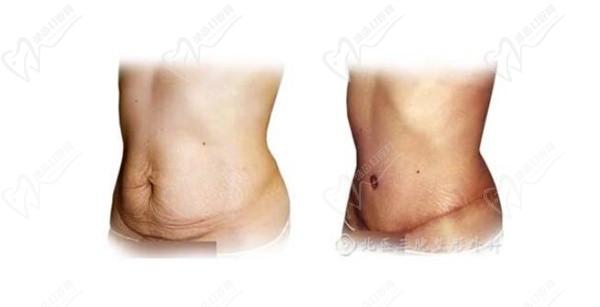 瞿健醫(yī)生腹壁整形怎么樣??？深度解析腹部拉皮技術(shù)優(yōu)勢與真實案例口碑反饋