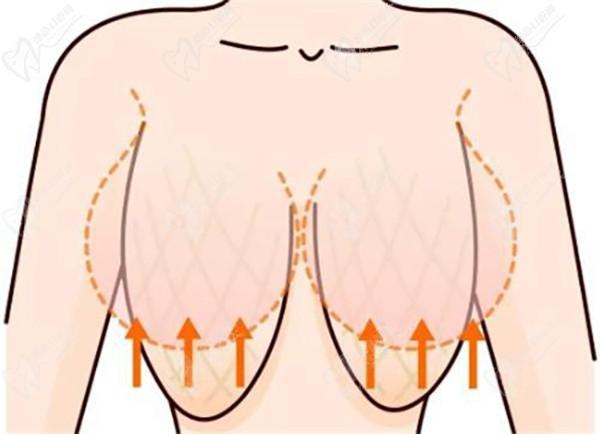 沈陽(yáng)于世川隆胸懸吊怎么樣？醫(yī)生實(shí)力與真實(shí)案例評(píng)測(cè)全解析